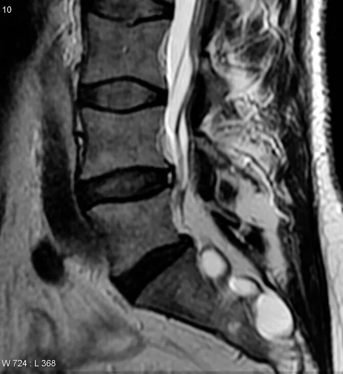 Киста в пояснице. Арахноидальная киста позвоночника s2. Периневральная киста l5-s1. Периневральная киста s2 корешка.