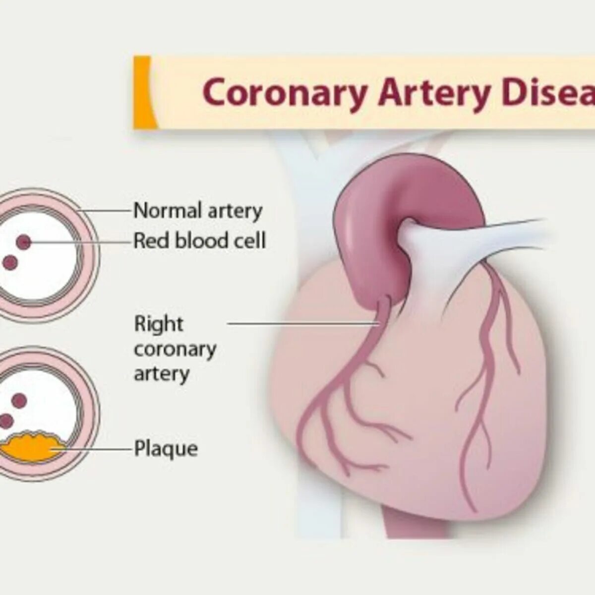 Атеросклероз коронарных артерий. Атеросклероз ибс стенокардия. Coronary disease. Coronary disease. Ишемическая болезнь сердца инфографика.