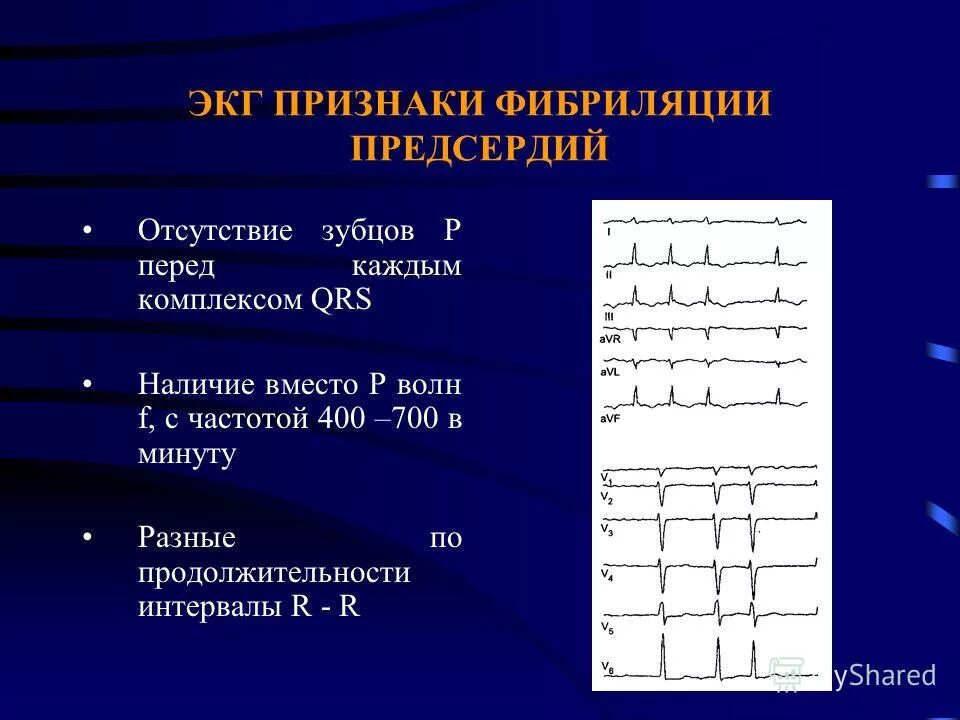 отсутствие комплекса qrs. деполяризация желудочков и комплекс qrs. отсутствие зубца т. появление комплекса qrs на экг. отсутствие комплекса qrs.