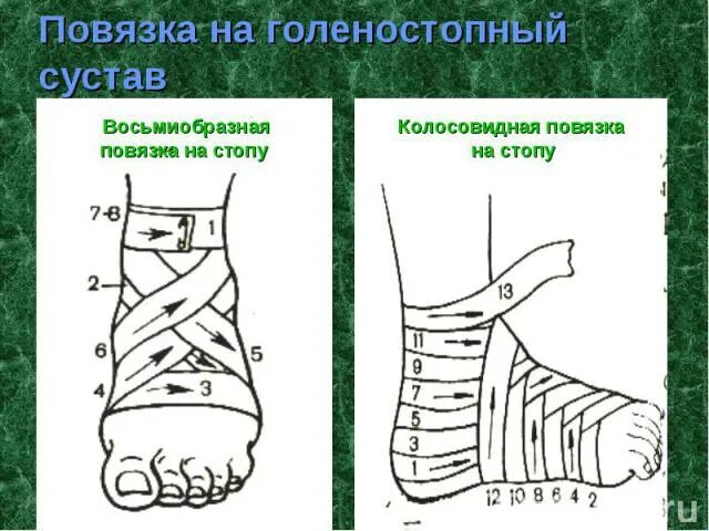 Какая повязка при повреждении голеностопного сустава. Техника наложения восьмиобразной повязки на голеностопный сустав. Тип повязки на голеностопный сустав. При растяжении голеностопных связок накладывается _______ повязка. Восьмиобразная повязка показания.