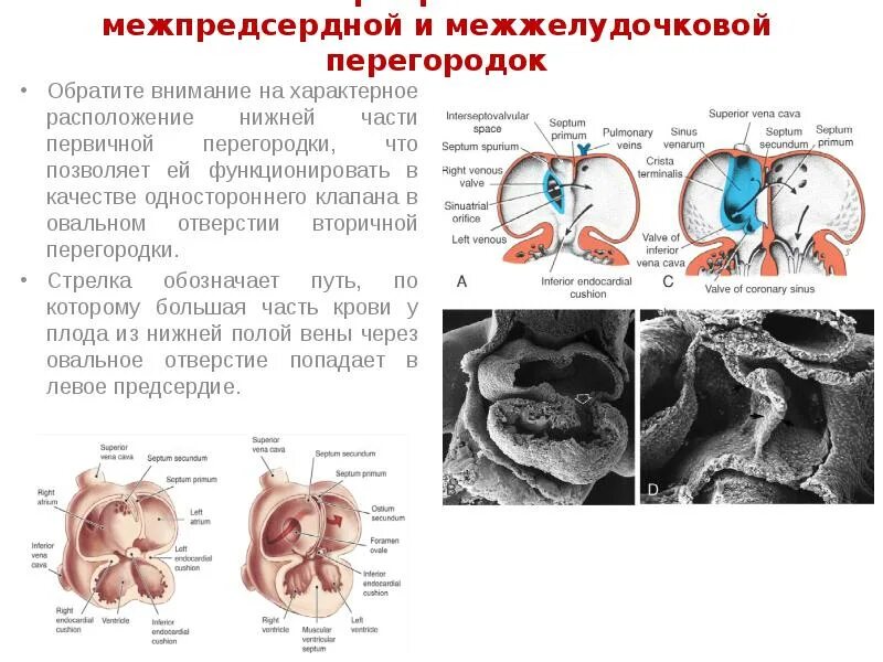 Аневризма перегородки у ребенка. Первичная и вторичная межпредсердная перегородка. Части межжелудочковой перегородки. Межжелудочковая перегородка анатомия. Аневризма межжелудочковой перегородки.