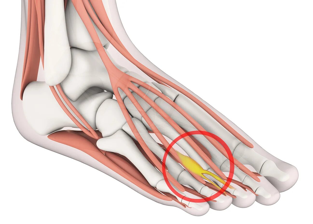 Невринома Мортона стопы. Межпальцевая неврома Мортона. Невринома Мортона синдром. Метатарзалгия неврома Мортона. Нейрома