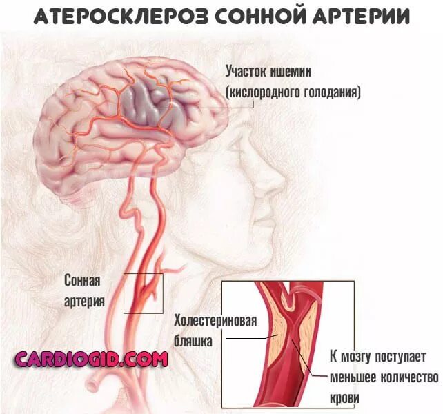 Причины сужения головного мозга. Атеросклеротическое поражение сосудов головного мозга. Ишемический инсульт сонной артерии. Атеросклероз сосудов сонных артерий. Атеросклероз сонных артерий осложнения.