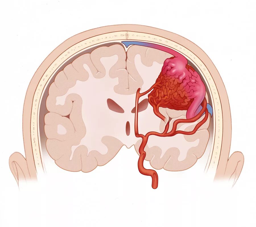 Сосудистая аномалия. Артериовенозная мальформация артерии. Мальформация сосудов головного мозга. Артериовенозные мальформации сосудов головного мозга. Субарахноидальное кровоизлияние и внутричерепное.