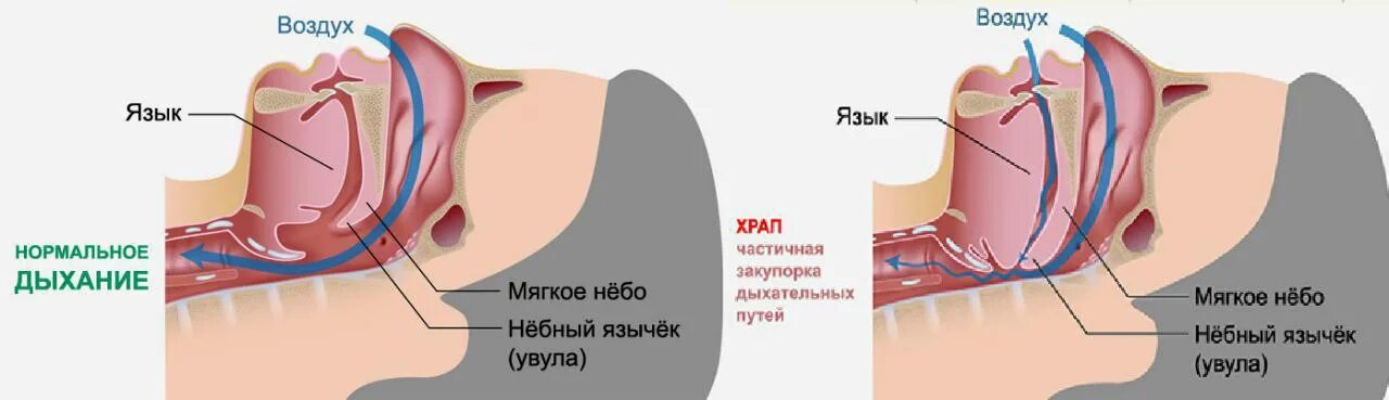 Почему любом положении человек храпит. Храп. причины храпа. физиология храпа человека.