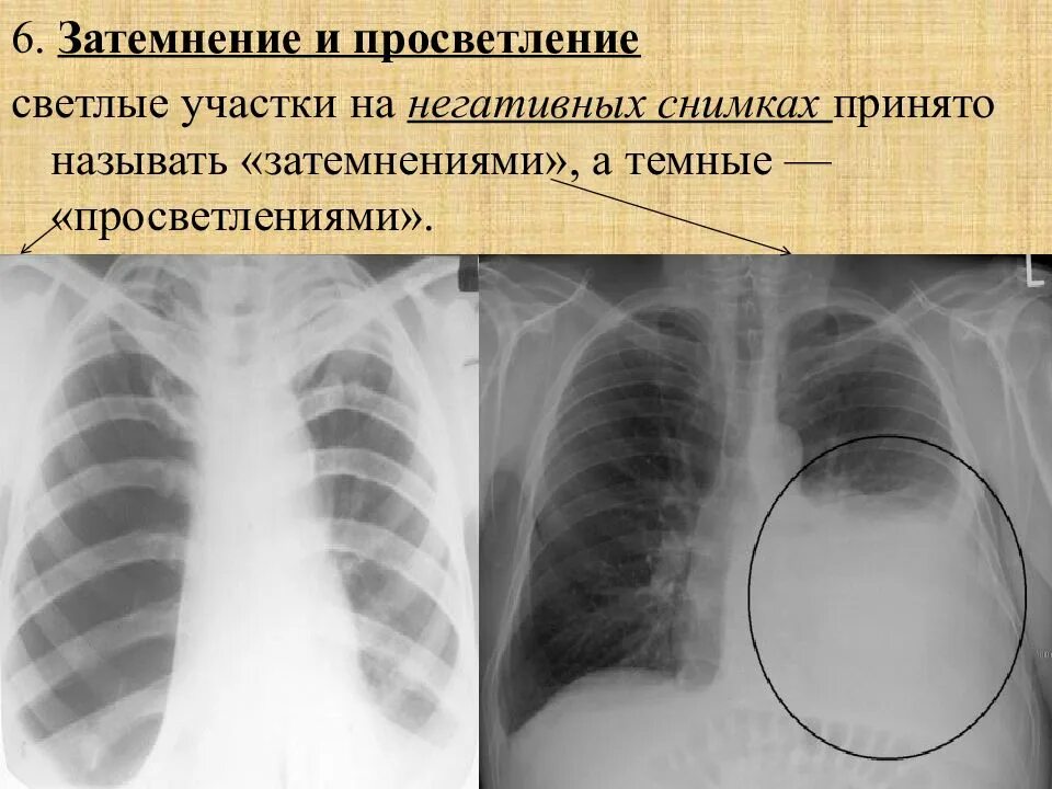 Затемнение рентгенограмма