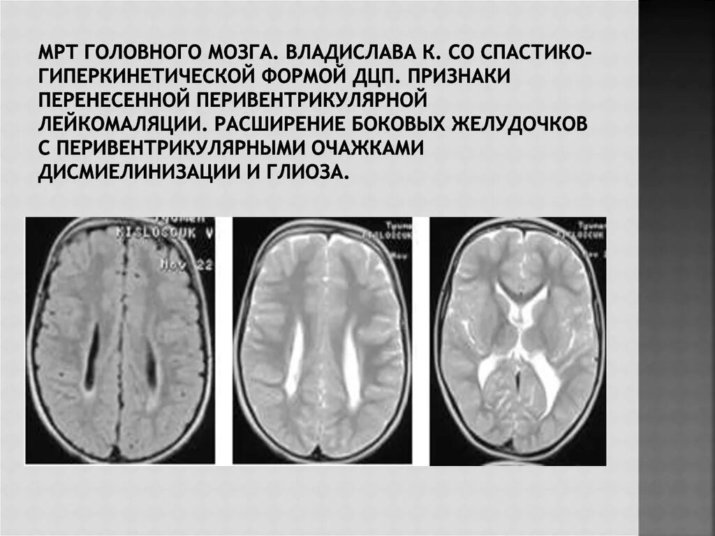 Дцп мозг. Мрт головного мозга при ДЦП. Кт мозга при ДЦП. Кт головного мозга при ДЦП. Изменения при ДЦП на кт головного мозга.