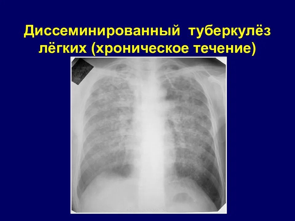 Острый диссеминированный туберкулез. Острый диссеминированный туберкулез рентген. Хронический диссеминированный туберкулез рентген. Лимфогенный диссеминированный туберкулез.