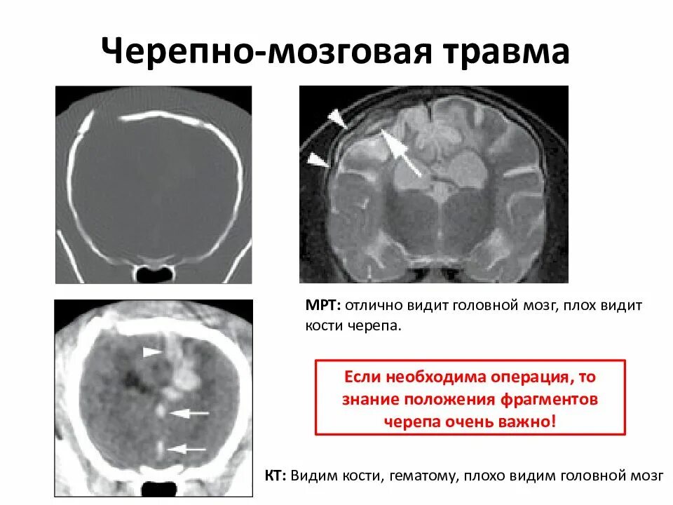 Мрт при сотрясении. Черепно-мозговая травма кт. Ушиб головного мозга легкой степени кт. Внутримозговая гематома кт. Ушиб головного мозга кт мрт.