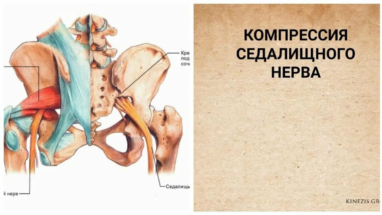 Мышца седалищного нерва. Компрессия седалищного нерва. Сдавление седалищного нерва. Укорочение грушевидной мышцы. Компрессия седалищного нерва грушевидной мышцей.