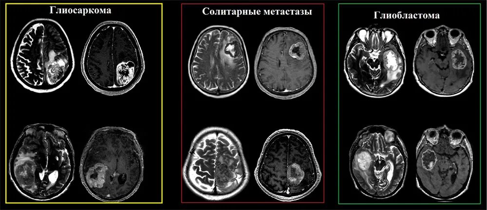 Глиосаркома гистология.