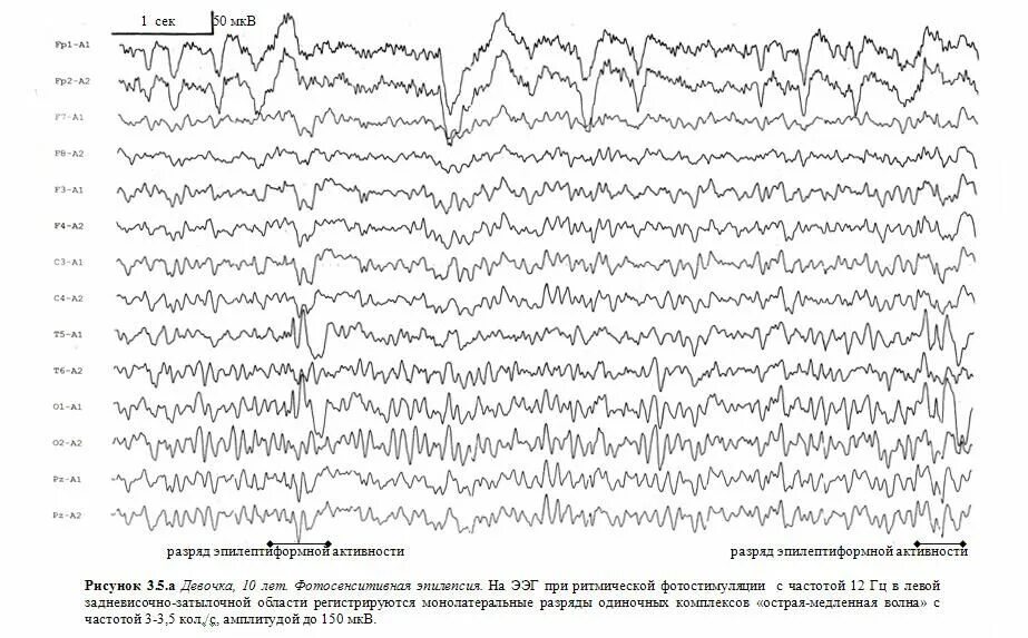 Легкие изменения ээг. Эпилептиформные паттерны на ЭЭГ. Эпилептиформная активность на ЭЭГ. ЭЭГ паттерны патологические. Полиспайки на ЭЭГ.