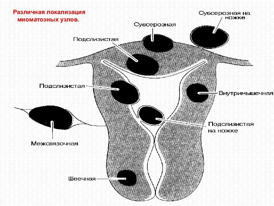 Миома матки локализация узлов. Миома матки классификация Figo. Шеечная локализация миомы. Миома тела матки классификация по размерам. Миома на задней стенке матки