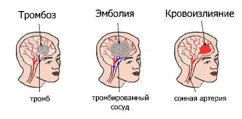 Тромб в ухе