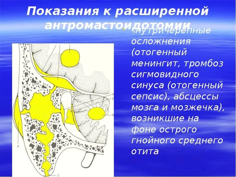 Отогенные осложнения. Отогенные внутричерепные осложнения. Отогенный менингит осложнения. Расширенная Антромастоидотомия. Отогенный тромбоз сигмовидного синуса.