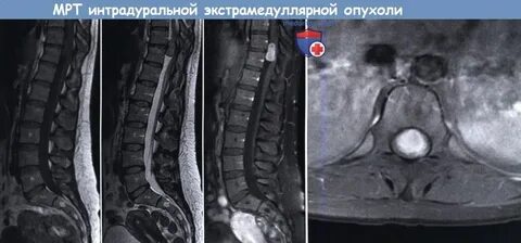 Опухоль поясничного