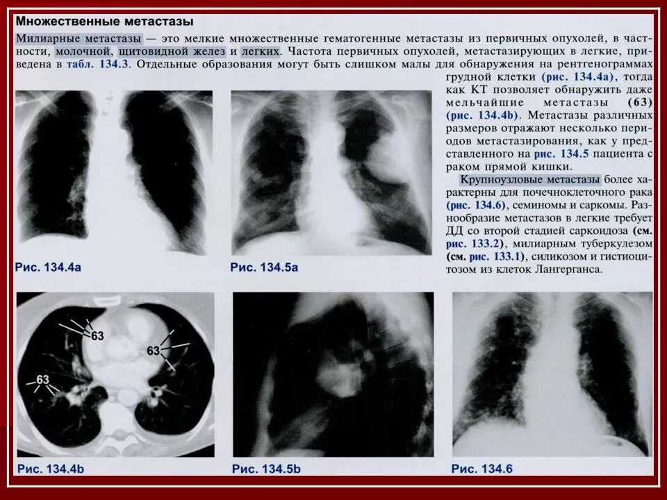 Метастазы в лёгких рентген заключение. Кт легких снимки с описанием. Метастазы на снимках кт. Признаки метастаз в легких