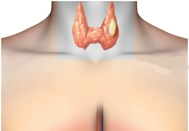 Припухлость щитовидки. Разрастание щитовидной железы. Признаки очаговых изменений щитовидной