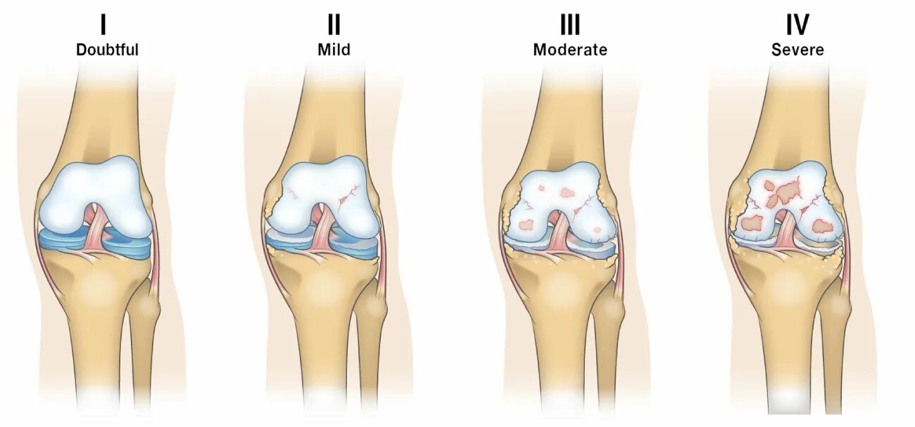 Kellgren Lawrence артроз коленного. Остеоартрит 1-2 степени коленного сустава. Стадии по Келлгрен Лоуренс коленного. Остеоартроз артрит 1 степени. Артроз коленного сустава название