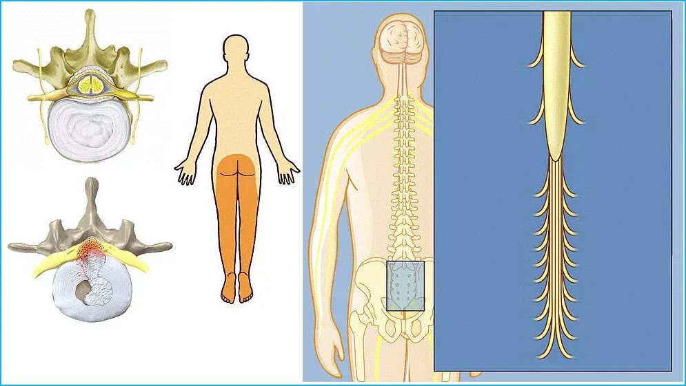 Корешки поясницы. Клиника поражения Корешков конского хвоста. Синдром поражения Корешков конского хвоста. Сдавливании Корешков конского хвоста. Поражение конского хвоста спинного мозга.