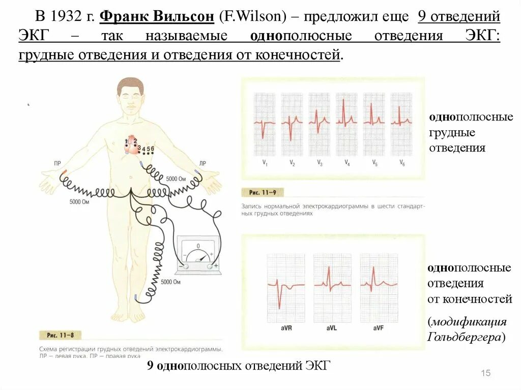 Грудные однополюсные отведения по Вильсону. Однополюсные грудные отведения ЭКГ. Ортогональные отведения по Франку. Отведения по Слопаку ЭКГ. Правые грудные отведения