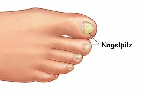 Российский Сервис Онлайн-Дневников Toenail fungus remedies, Foot fungus treatmen