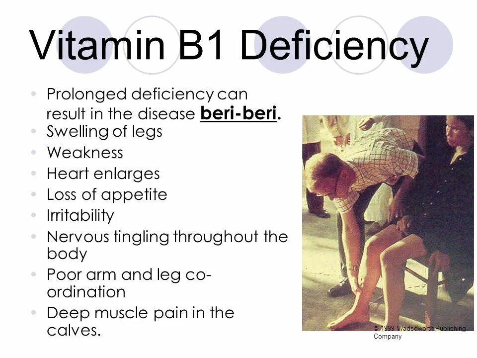 This can result in. Болезнь бери-бери картинки. Болезнь бери бери фото больных.