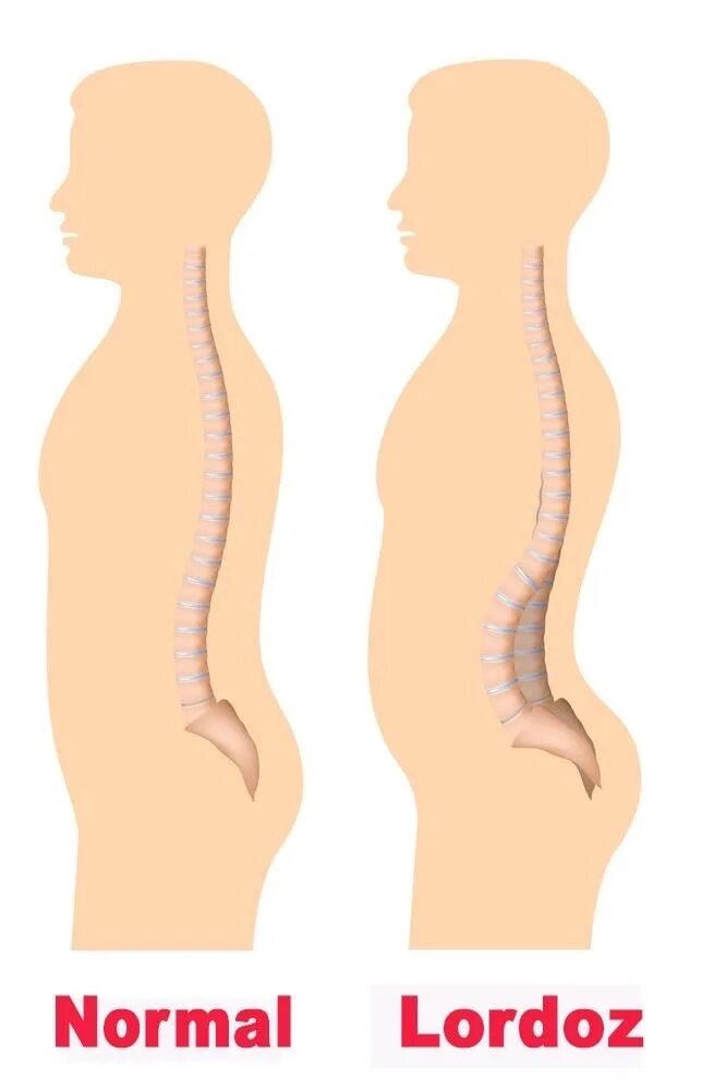 Лордоз поясничный гиперлордоз. Сглажен лордоз в поясничном отделе позвоночника. Кифоз и гиперлордоз. Поясничный лордоз рентген. Гиперлордоз и выпирающий живот