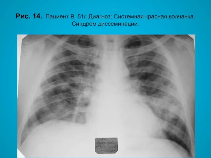 Диагностические критерии системной красной волчанки. Перикардит плеврит пневмонит. Поражение сердца при системной красной волчанке. Скв рентгенологические признаки. Скв поражение нервной системы.
