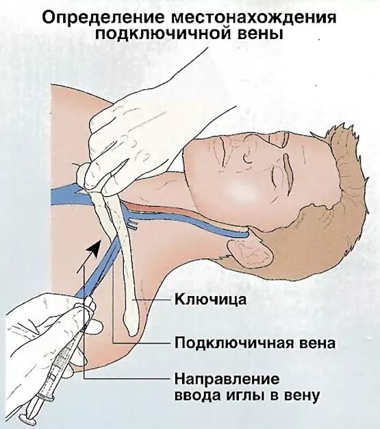 Уход за подключичным катетером. Внутренняя яремная Вена катетеризация. Внутренняя ярёмная Вена катетеризация вен. Яремная Вена техника катетеризации. Катетер яремный катетер.