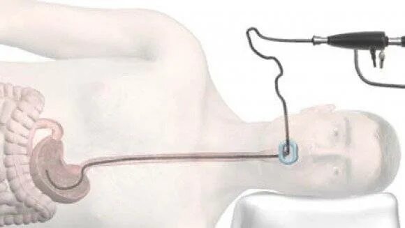 Трубка через рот. Двенадцатиперстная кишка ФГДС. Аппарат ФГС 8мм. Гастроскопия желудка гастрит.