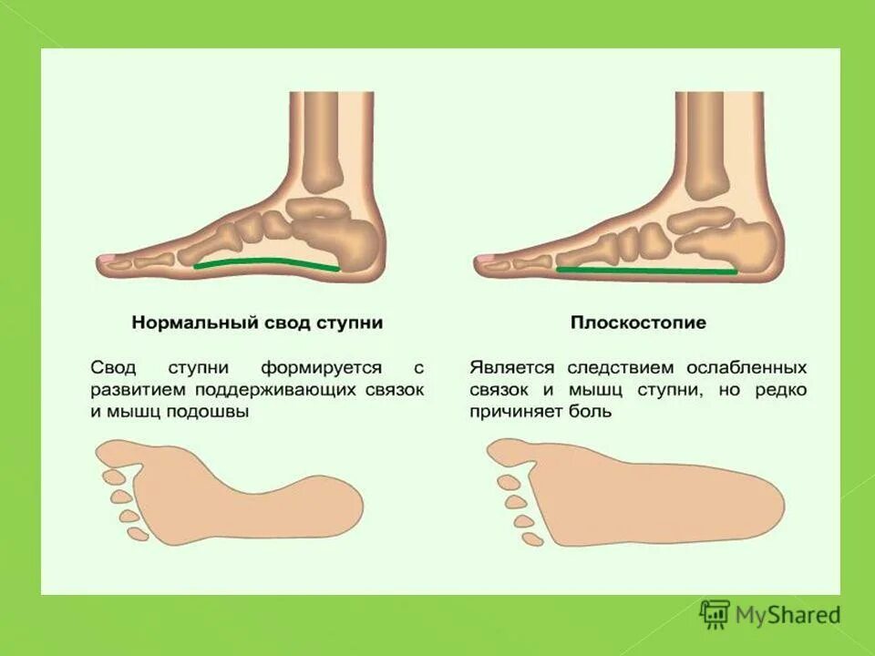 Продольный и поперечный свод стопы. Строение сводов стопы. Мышцы укрепляющие своды стопы. Строение сводов стопы. Схема продольного свода стопы.
