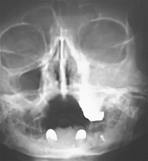 Острый двухсторонний верхнечелюстной синусит. Острый гайморит рентгенограмма. Отек гайморовой пазухи рентген. Правосторонний гнойный