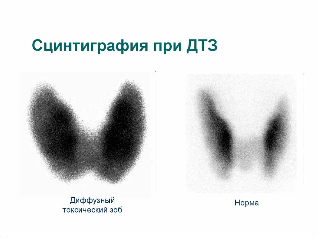 Диффузный зоб диагностика. Сцинтиграфия щитовидной железы ДТЗ. Сцинтиграфия щитовидной железы при ДТЗ. Сцинтиграфия щитовидной железы диффузный токсический зоб. Болезнь Грейвса сцинтиграфия.