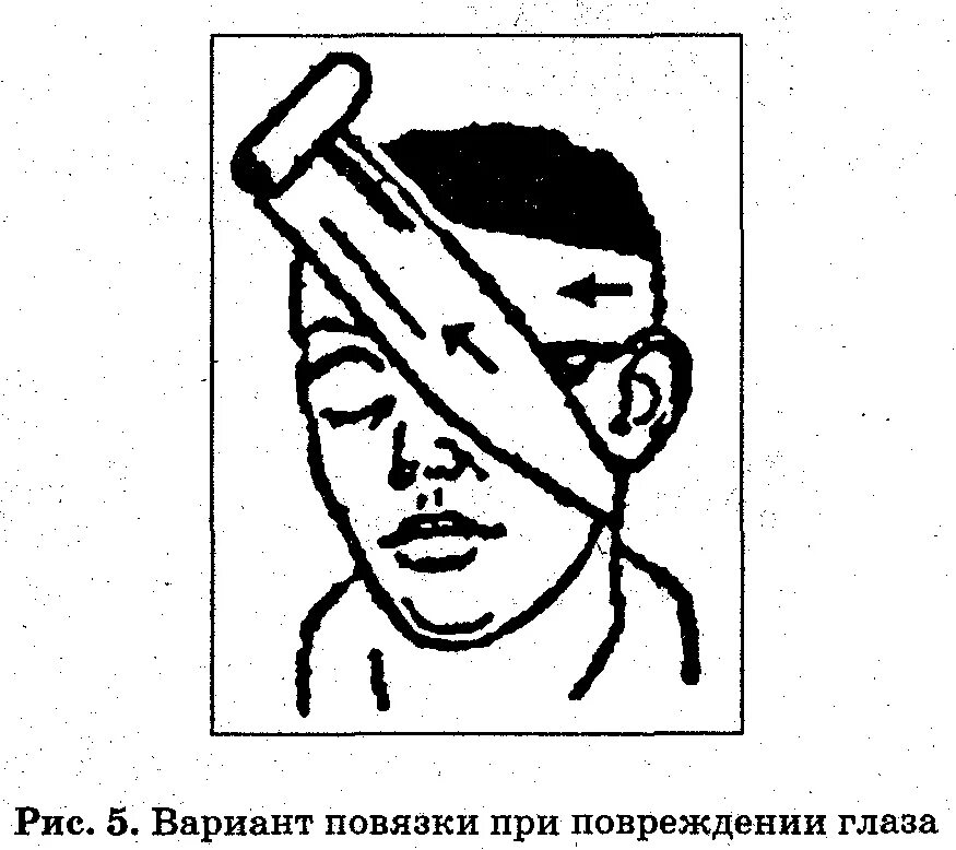 Повязка при черепно-мозговой травме. Оказание первой помощи при травме головы. Повязка при ЧМТ. Оказание ПМП при травме головы.