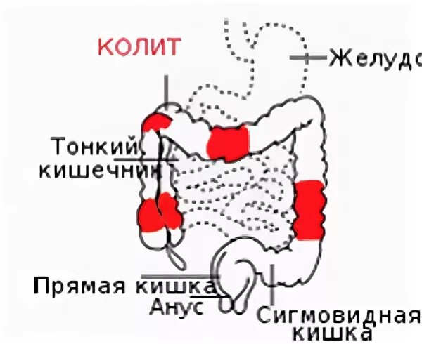 Колющая боль в заднем проходе. Локализация боли в кишечнике. Тонкий кишечник локализация боли.