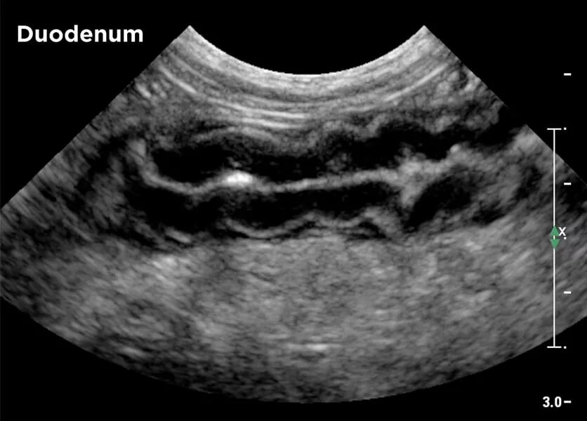 Лимфома кишечника у кошек УЗИ. Язва желудка снимок УЗИ. УЗИ двенадцатиперстной кишки.