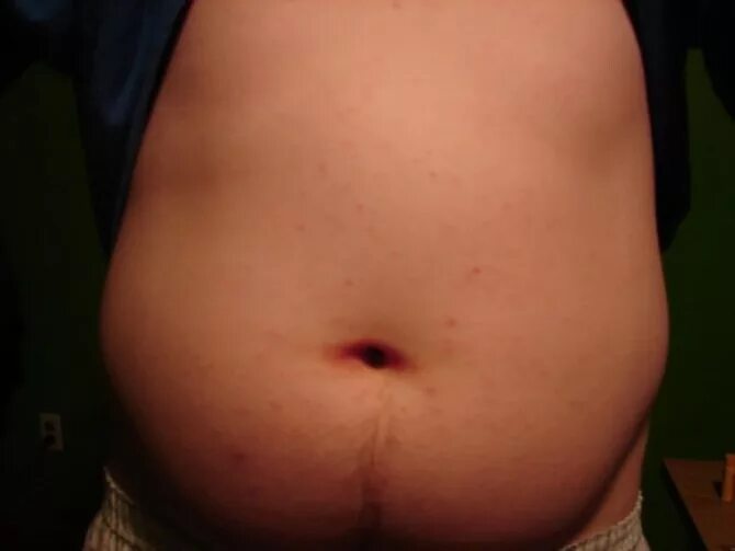 Красные пятнышки на животе. Беременность для кожи лица. Боль в яичниках при беременности. Прыщик на пояснице у беременной на раннем сроке. Болят яичники при беременности.