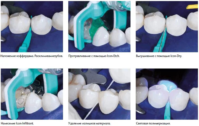 Айкон инфильтрант кариеса. Инфильтрация кариеса методом "icon". Лечение кариеса эмали методом инфильтрации (icon). Технология Айкон в стоматологии. Лечение кариеса ульяновск