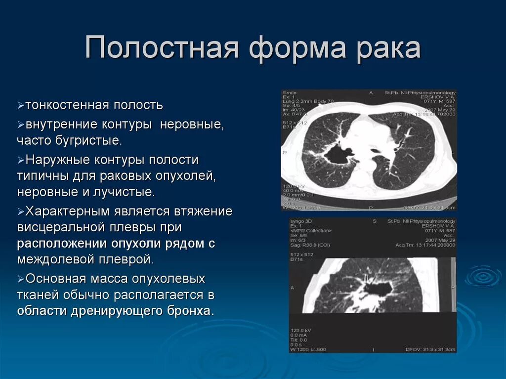 Полости распада в легких на кт. Тонкостенные полости в легких на кт. Полостные образования в легких