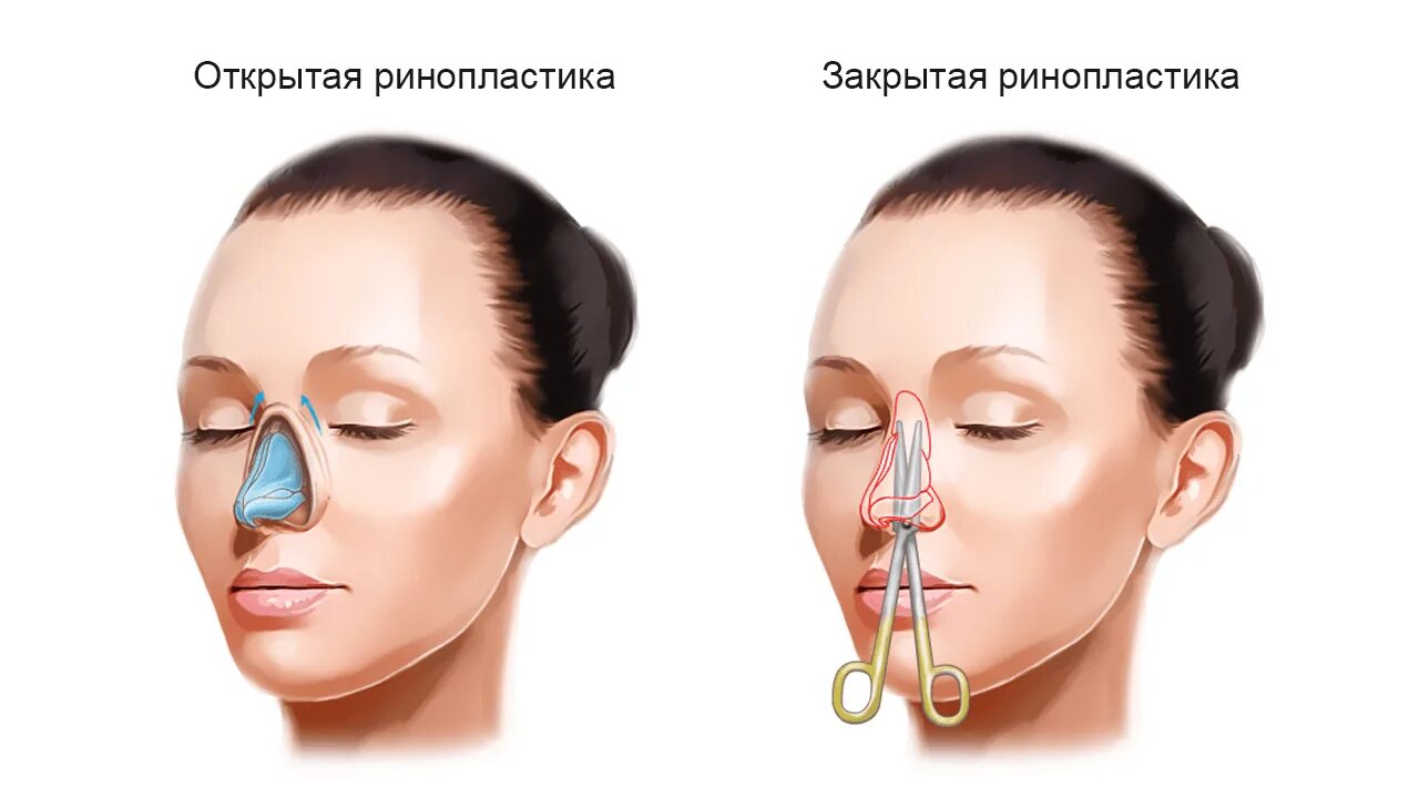 Ринопластика. Пластика носа. Открытая и закрытая ринопластика. Ринопластика носа.