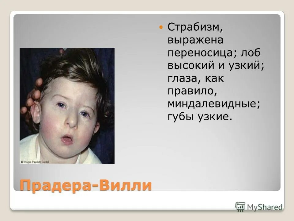Синдром парадевили. Синдром пирадеравелли. Синдром парадевили. Синдром прадера-вилься. Синдром парадевили.