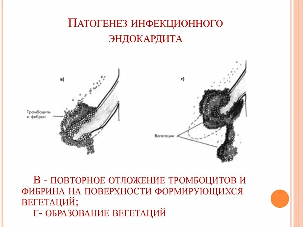 Инфекционный эндокардит клинические рекомендации 2021. Инфекционный эндокардит патогенез. Патогенез инфекционного эндокардита кратко. Инфекционный септический эндокардит патогенез. Вегетация сердца