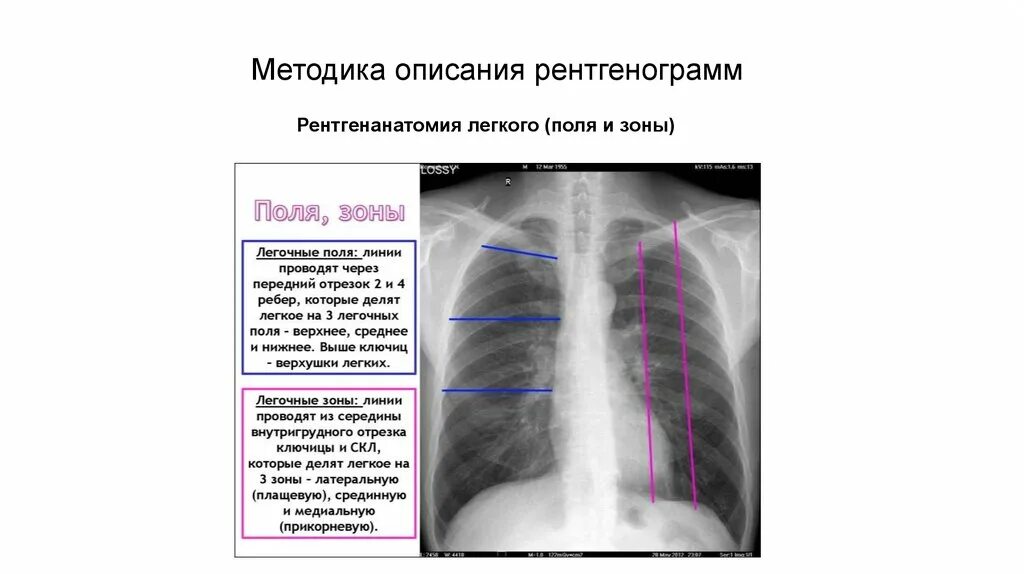 Лучевые заболевания легких. Рентгенодиагностика заболеваний легких. Рентгенанатомия легких. Легочные поля и зоны. Легочные поля на рентгенограмме.