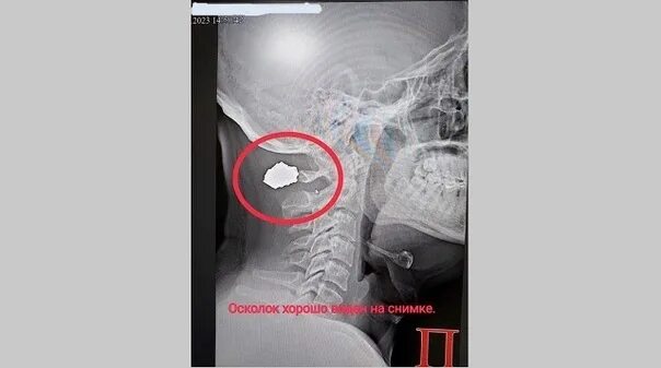 Может ли осколок. Осколки извлеченные из тела. осколок в теле ранение.