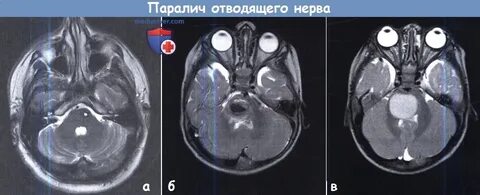 Паралич черепных нервов