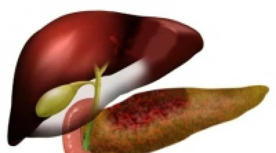 Фибролипоматоз поджелудочной железы что это. Панкреонекроз поджелудочной железы. Панкреонекроз поджелудочной железы симптомы. Некроз поджелудочной железы.