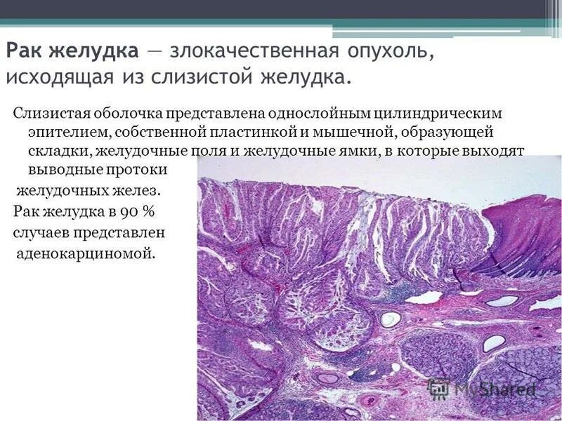Полиморфноклеточной инфильтрацией. Визуальная аналоговая шкала. Эзофагит препараты патанатомия. Нейтрофильная инфильтрация слизистой желудка. Инфильтрация собственной пластинки слизистой оболочки.