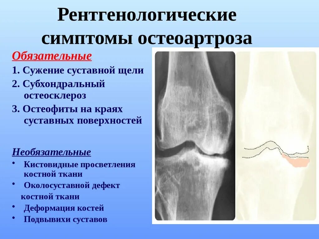Остеоартроз 1 2 степени коленного сустава. Рентген признаки остеоартроза. Деформирующий остеоартроз рентген. Сужение суставной щели остеоартроз.