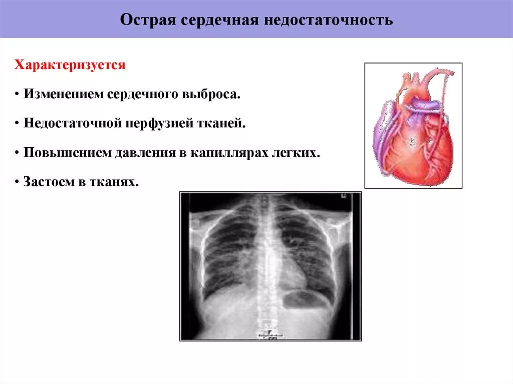 Острая сердечная недостаточность тема. Острая сердечная недостаточность характеризуется. Острая саидечнпя недост. Острая сердечнаямнедостаточность. Подострая сердечная недостаточность.